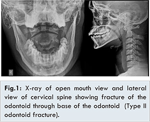 Posterior screw fixation odontoid fracture - luacount